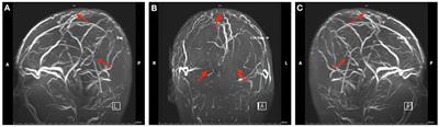 Cyclosporine-A-Induced Intracranial Thrombotic Complications: Systematic Review and Cases Report